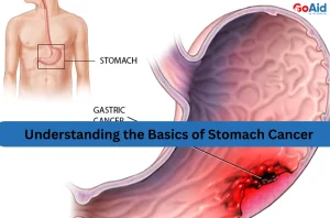 Understanding the Basics of Stomach Cancer