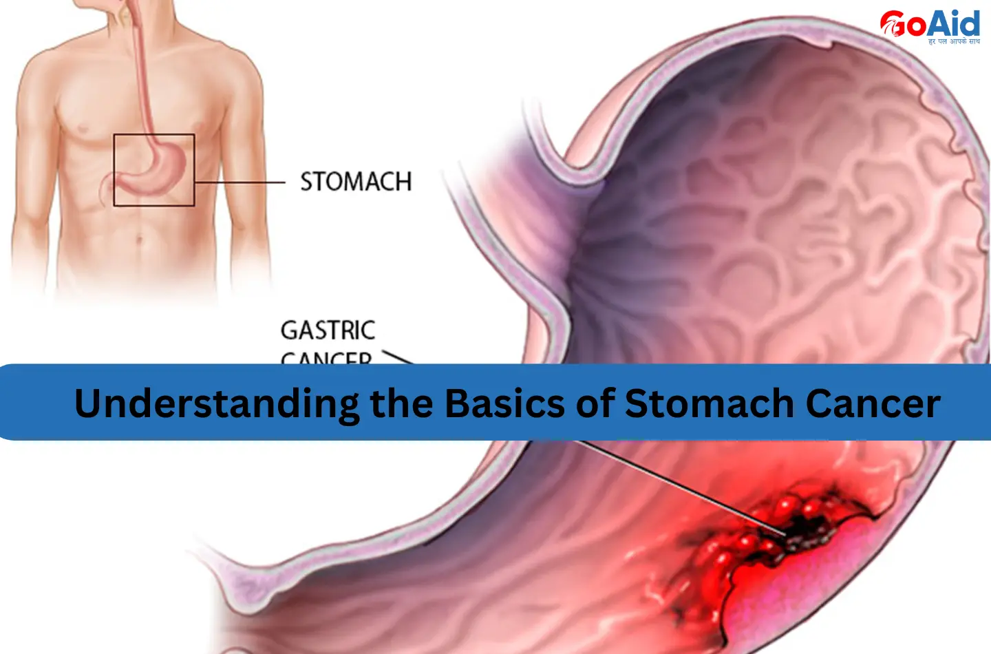 Understanding the Basics of Stomach Cancer